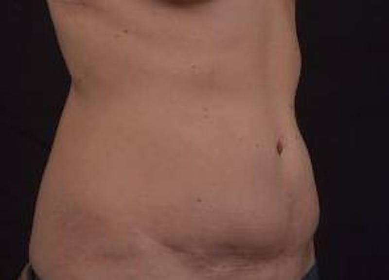 Abdominoplasty Before & After Gallery - Patient 126687 - Image 9