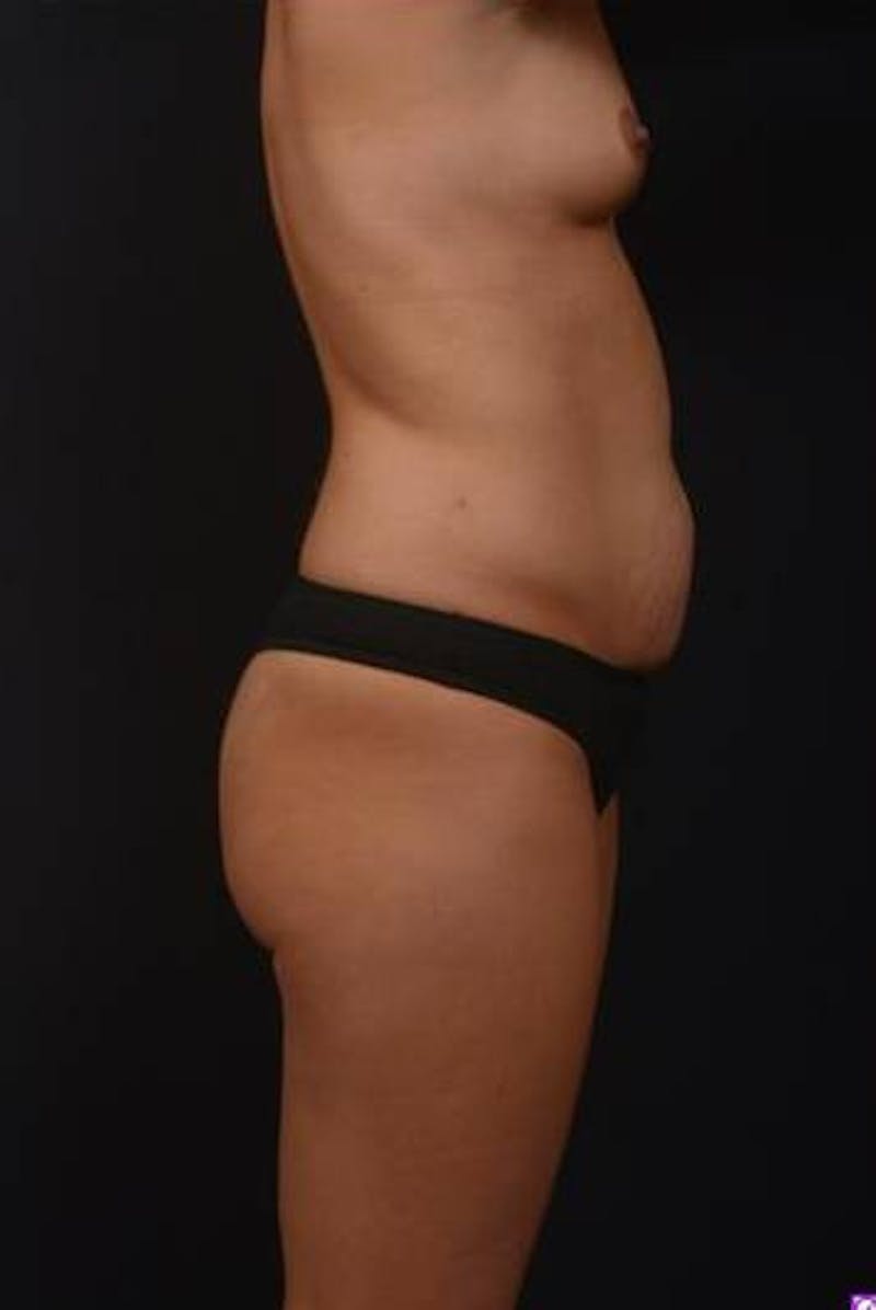 Mommy Makeover Before & After Gallery - Patient 281307 - Image 9