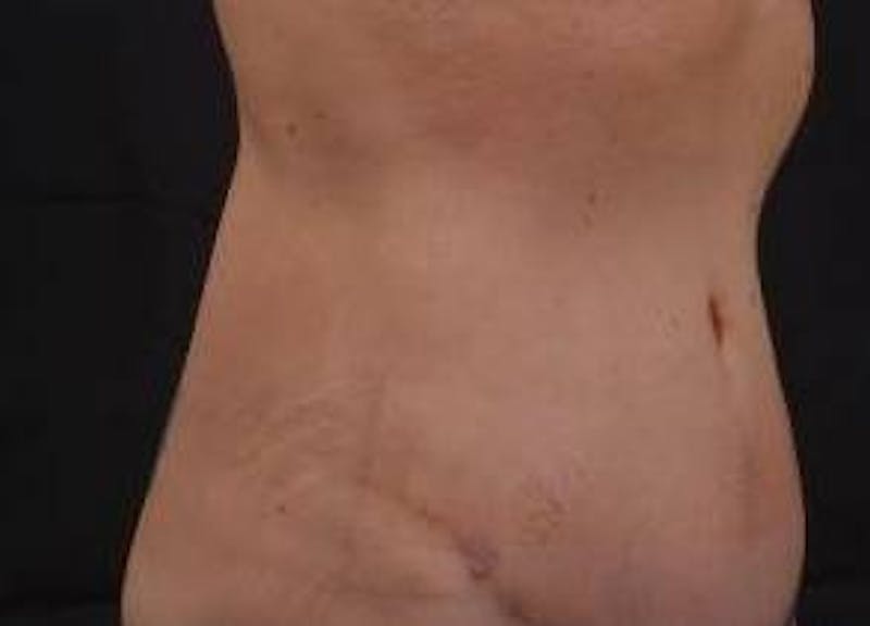 Abdominoplasty Before & After Gallery - Patient 126687 - Image 10
