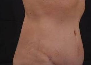 Abdominoplasty Before & After Gallery - Patient 126687 - Image 10