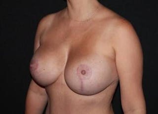 Breast Augmentation Mastopexy Before & After Gallery - Patient 164036 - Image 4