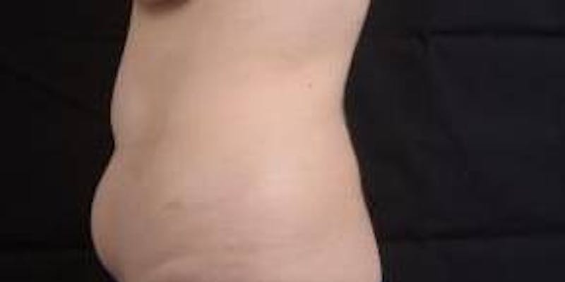 Abdominoplasty Before & After Gallery - Patient 137865 - Image 3