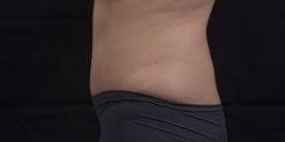 Abdominoplasty Before & After Gallery - Patient 137865 - Image 4