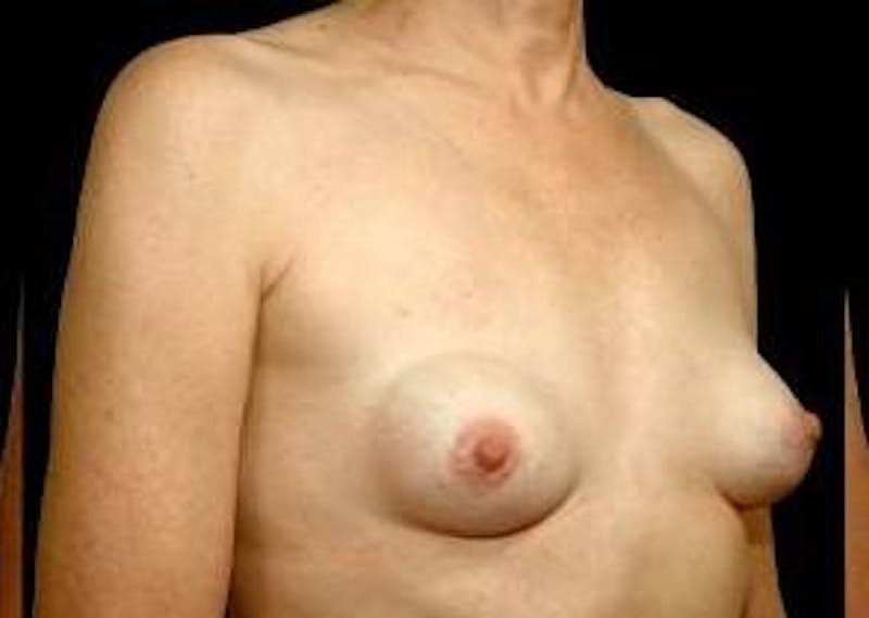 Aesthetic Breast Revision Before & After Gallery - Patient 344700 - Image 3