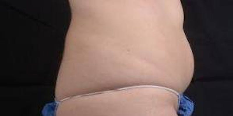 Abdominoplasty Before & After Gallery - Patient 137865 - Image 5