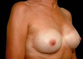 Aesthetic Breast Revision Before & After Gallery - Patient 344700 - Image 4