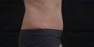 Abdominoplasty Before & After Gallery - Patient 137865 - Image 6