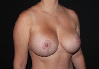 Breast Augmentation Mastopexy Before & After Gallery - Patient 164036 - Image 8