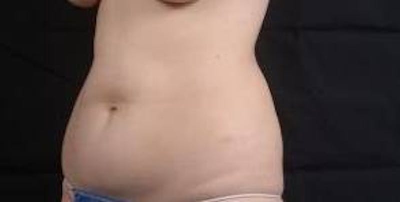 Abdominoplasty Before & After Gallery - Patient 137865 - Image 7
