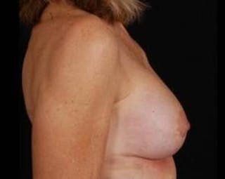Aesthetic Breast Revision Before & After Gallery - Patient 188938 - Image 4