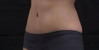 Abdominoplasty Before & After Gallery - Patient 137865 - Image 8