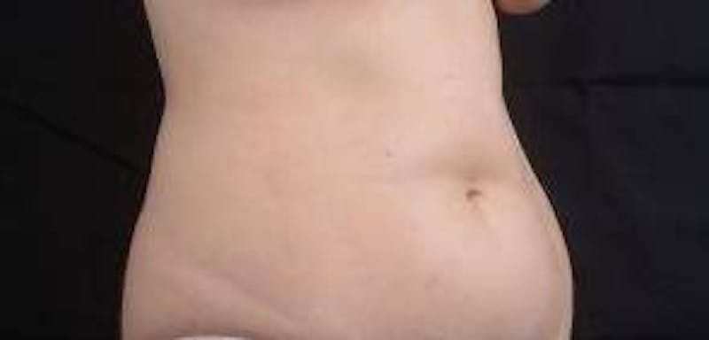 Abdominoplasty Before & After Gallery - Patient 137865 - Image 9
