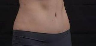 Abdominoplasty Before & After Gallery - Patient 137865 - Image 10