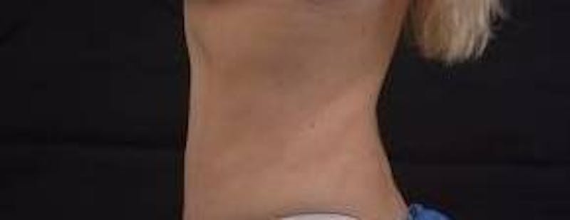 Abdominoplasty Before & After Gallery - Patient 250524 - Image 3