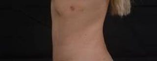 Abdominoplasty Before & After Gallery - Patient 250524 - Image 4