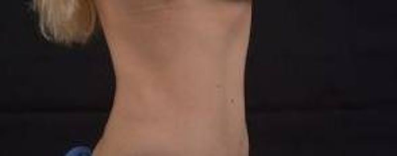 Abdominoplasty Before & After Gallery - Patient 250524 - Image 5