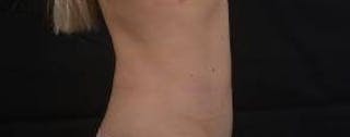 Abdominoplasty Before & After Gallery - Patient 250524 - Image 6