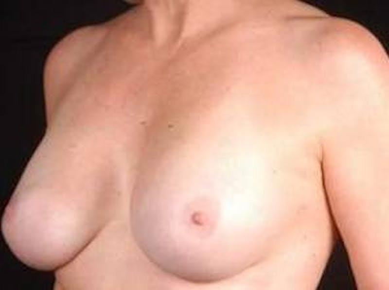 Aesthetic Breast Revision Before & After Gallery - Patient 169700 - Image 4