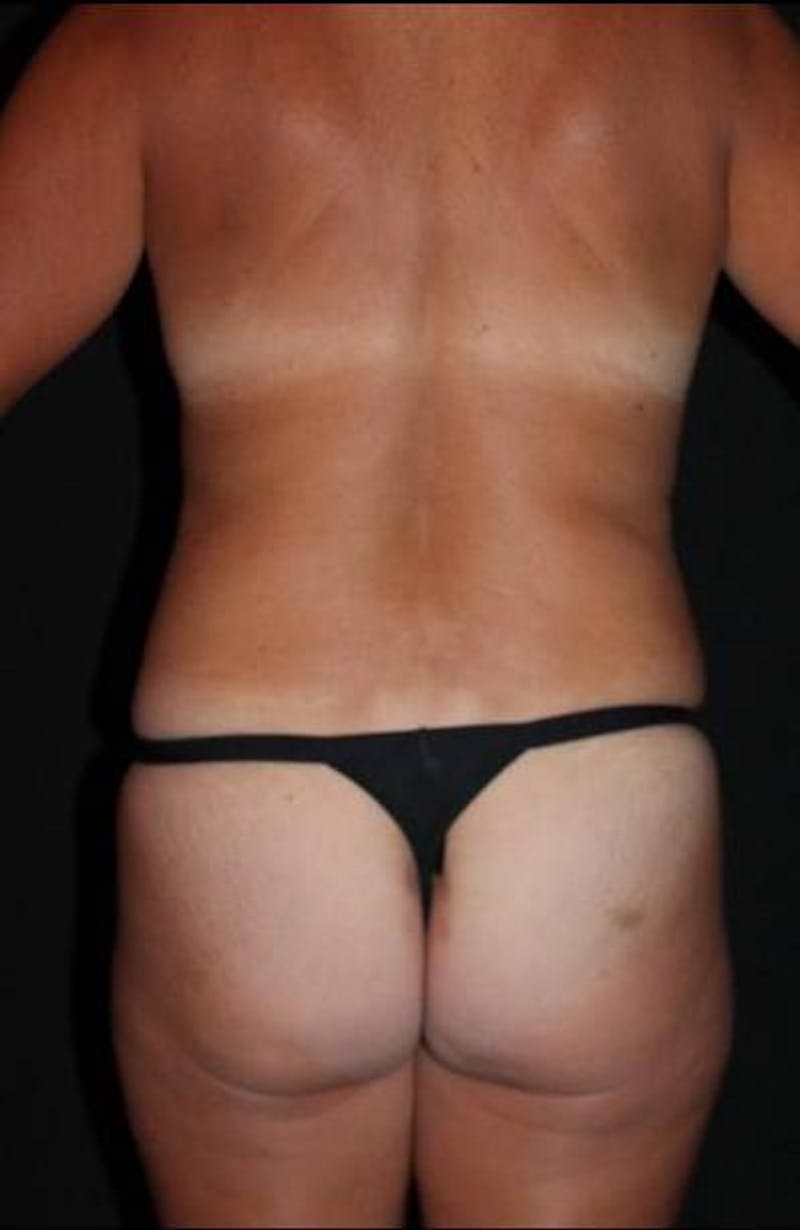 Mommy Makeover Before & After Gallery - Patient 401685 - Image 11