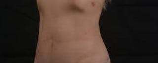 Abdominoplasty Before & After Gallery - Patient 250524 - Image 8