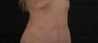 Abdominoplasty Before & After Gallery - Patient 250524 - Image 10