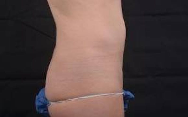 Mommy Makeover Before & After Gallery - Patient 362996 - Image 3