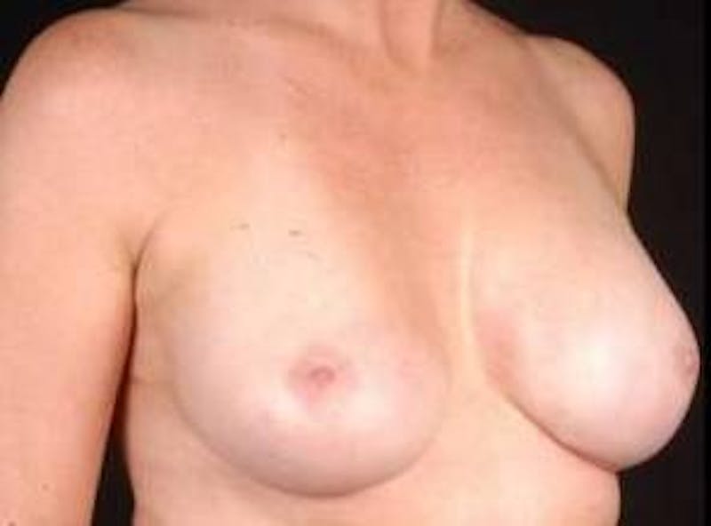 Aesthetic Breast Revision Before & After Gallery - Patient 169700 - Image 6