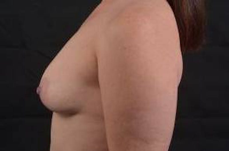 Breast Augmentation Silicone Gel Before & After Gallery - Patient 367191 - Image 3