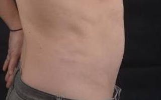 Mommy Makeover Before & After Gallery - Patient 362996 - Image 4