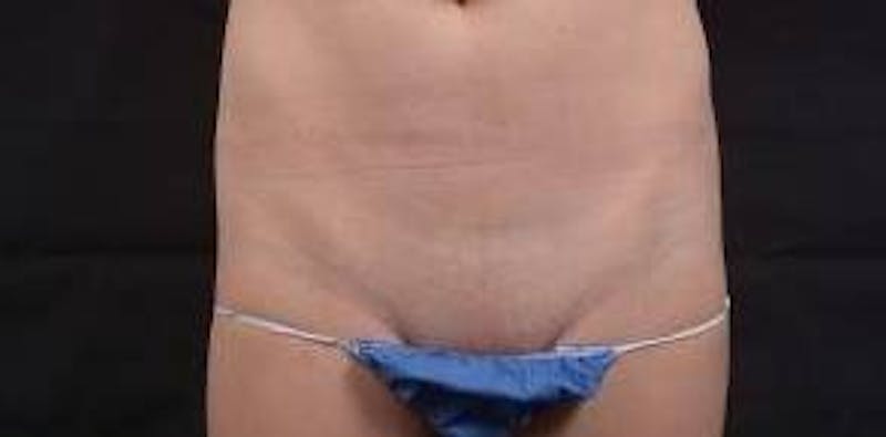 Mommy Makeover Before & After Gallery - Patient 362996 - Image 9