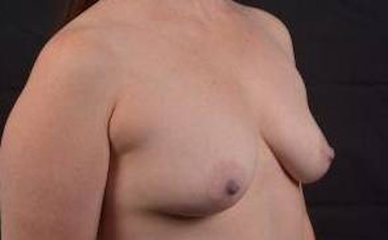 Breast Augmentation Silicone Gel Before & After Gallery - Patient 367191 - Image 9