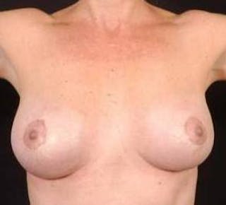 Aesthetic Breast Revision Before & After Gallery - Patient 116019 - Image 4