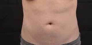 Mommy Makeover Before & After Gallery - Patient 362996 - Image 10