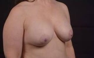 Breast Augmentation Silicone Gel Before & After Gallery - Patient 367191 - Image 10