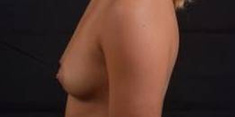 Breast Augmentation Silicone Gel Before & After Gallery - Patient 398485 - Image 3