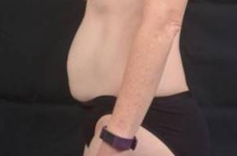 Abdominoplasty Before & After Gallery - Patient 297964 - Image 3