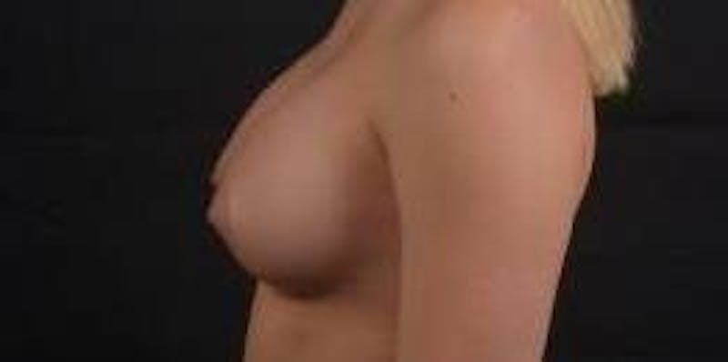 Breast Augmentation Silicone Gel Before & After Gallery - Patient 398485 - Image 4
