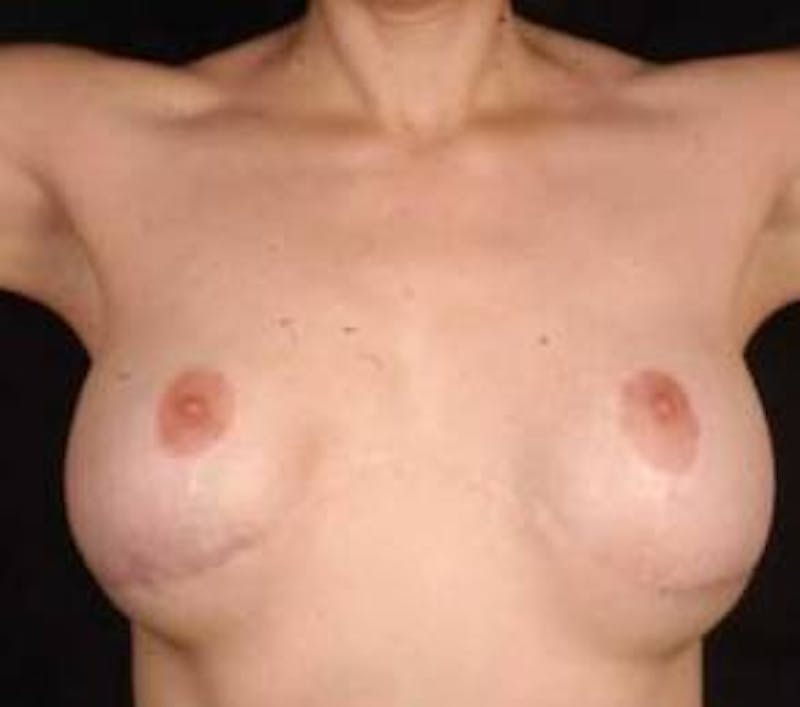 Aesthetic Breast Revision Before & After Gallery - Patient 101809 - Image 3
