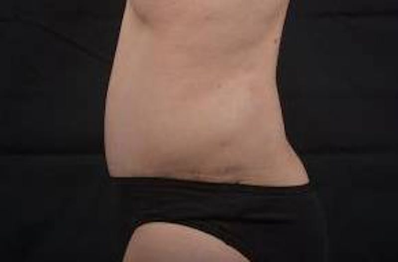 Abdominoplasty Before & After Gallery - Patient 297964 - Image 4