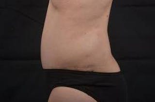 Abdominoplasty Before & After Gallery - Patient 297964 - Image 4