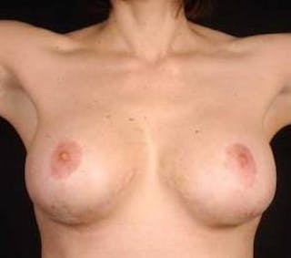 Aesthetic Breast Revision Before & After Gallery - Patient 101809 - Image 4