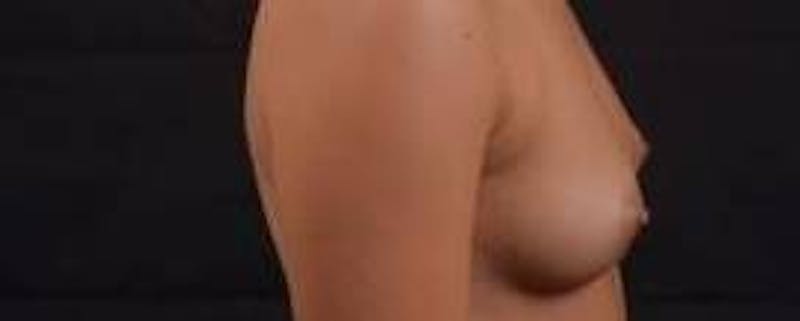 Breast Augmentation Silicone Gel Before & After Gallery - Patient 398485 - Image 5