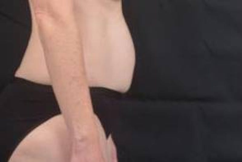 Abdominoplasty Before & After Gallery - Patient 297964 - Image 5