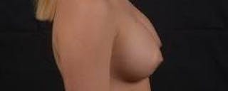 Breast Augmentation Silicone Gel Before & After Gallery - Patient 398485 - Image 6