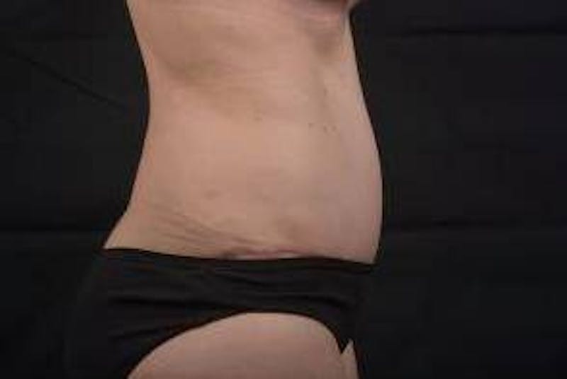 Abdominoplasty Before & After Gallery - Patient 297964 - Image 6