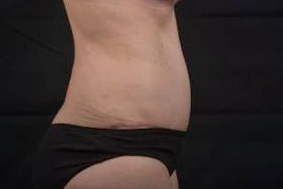 Abdominoplasty Before & After Gallery - Patient 297964 - Image 6