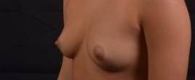 Breast Augmentation Silicone Gel Before & After Gallery - Patient 398485 - Image 7