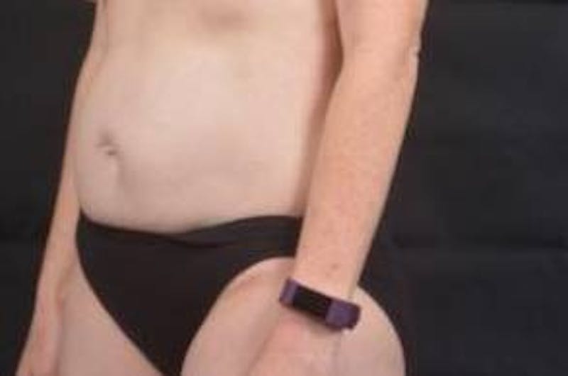 Abdominoplasty Before & After Gallery - Patient 297964 - Image 7
