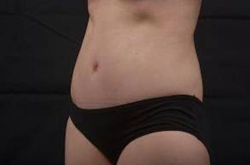 Abdominoplasty Before & After Gallery - Patient 297964 - Image 8