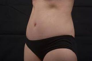 Abdominoplasty Before & After Gallery - Patient 297964 - Image 8